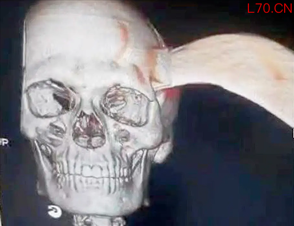 印度男子头插砍刀淡定玩手机 惊险一幕疯传网络